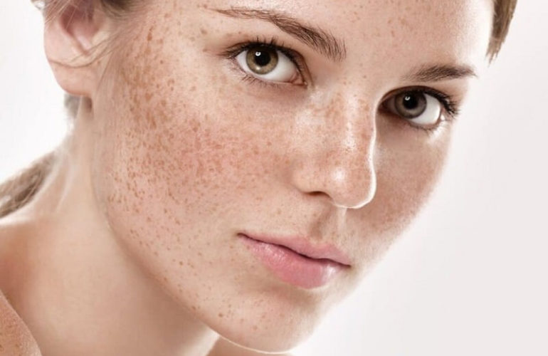 Phân loại nám da poly k-beauty