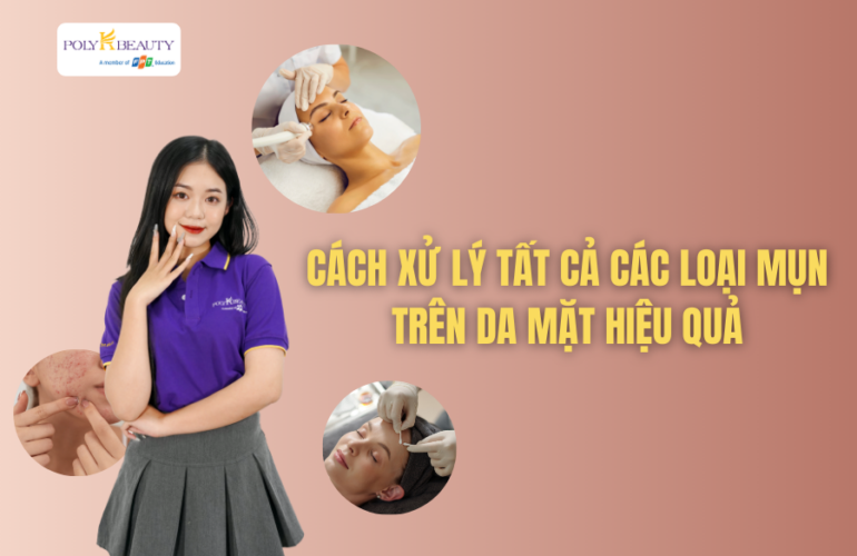 Cách xử lý triệt để tất cả các loại mụn trên da mặt hiệu quả, nhanh chóng nhất