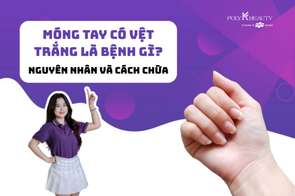 Móng tay có vệt trắng là bệnh gì? nguyên nhân và cách chữa trị