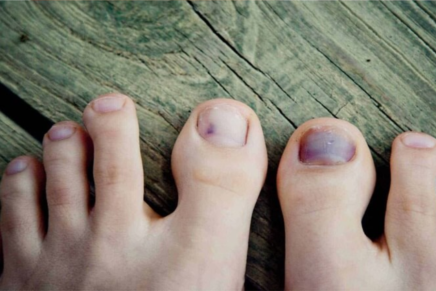Móng chân đen là như thế nào?