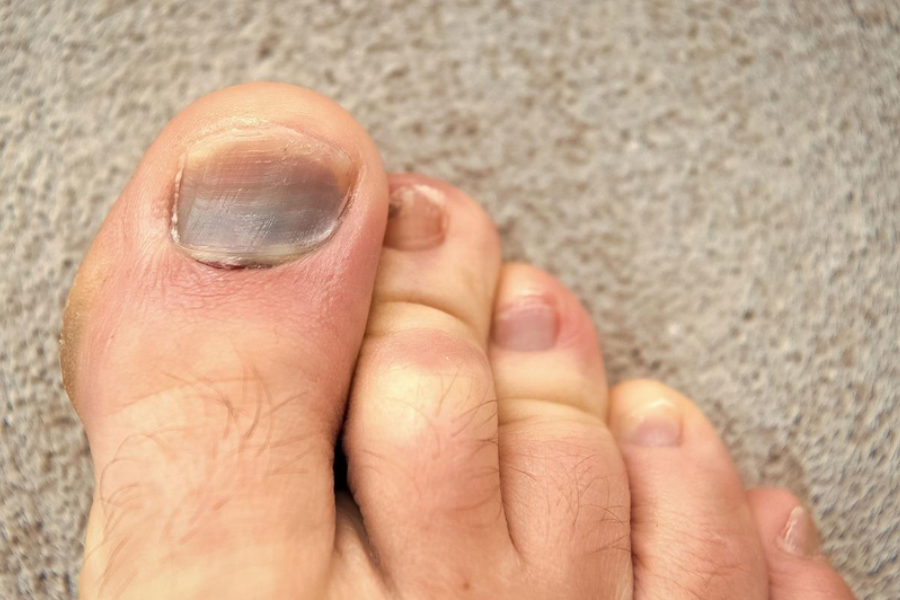 Nguyên nhân khiến móng chân bị đen