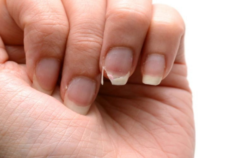 Nguyên nhân khiến móng tay yếu, dễ gãy