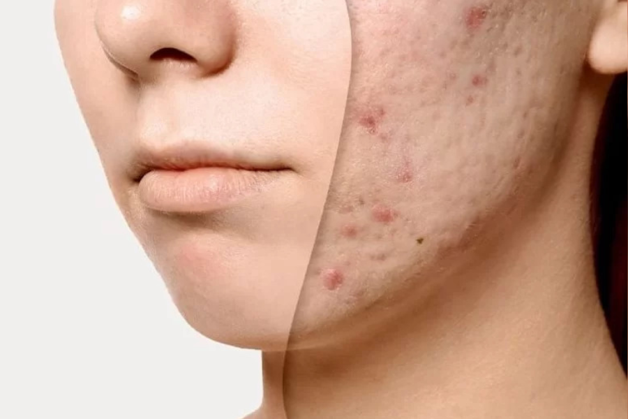 Da mặt bị sần sùi, không mịn màng là gì?