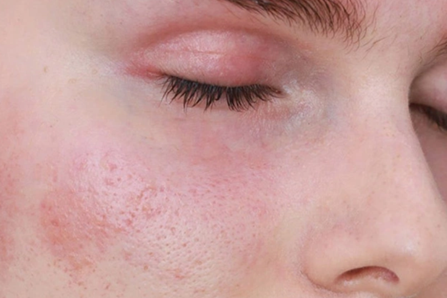 Những lưu ý khi điều trị mụn